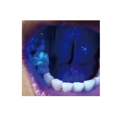Dentmate LUMINDEX3 Plaque LED EXAMINATION Light2