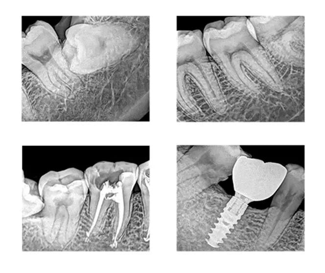 Xpect vision Dental Digital Intraoral Sensor Adult & Pedo Bundle Pkg