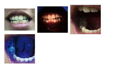 Dentmate LUMINDEX3 Plaque LED EXAMINATION Light3