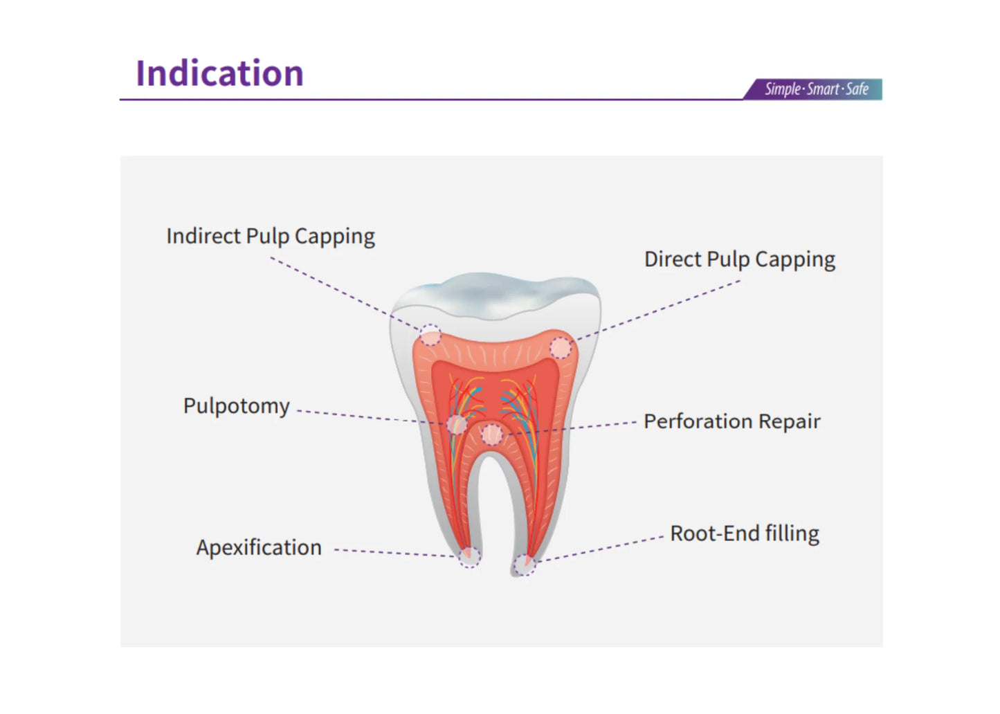 EndoCem Root Repair MTA Premix in a syringe