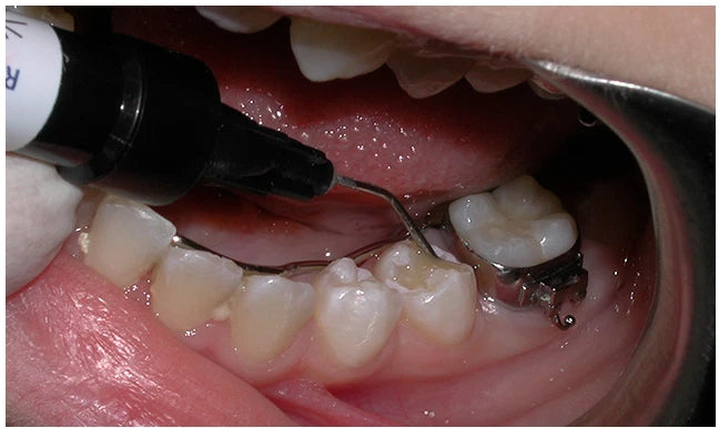 Premier® BioCoat new bioactive resin pit and fissure sealant 1.2mL Syringe