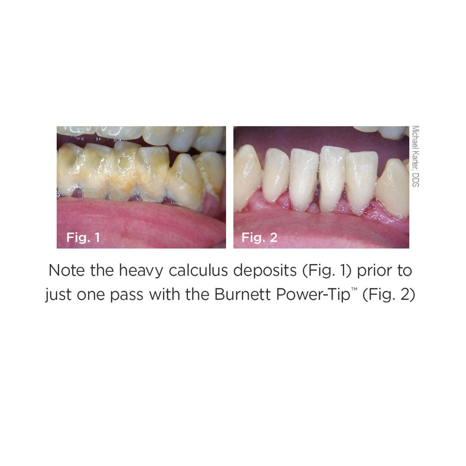 Parkell Inserts Parkell 30KHz Comfort Grip Slim Inserts – Tri County Dental Supply