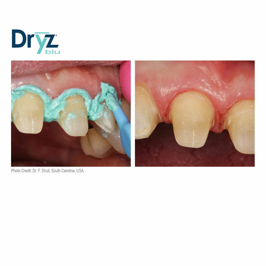 Parkell Dryz Blu Syringe Hemostatic Retraction Paste Syringes