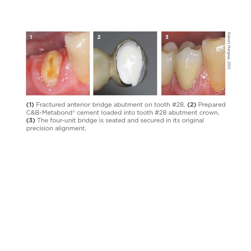 Parkell C&B Metabond Quick Adhesive Cement System